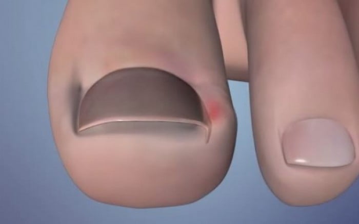 Νύχια που μπαίνουν στο δέρμα: Δείτε γιατί συμβαίνει (βίντεο)