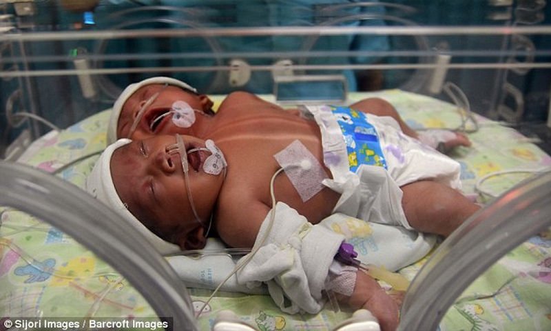 Μωρό με δύο κεφάλια γεννήθηκε στην Ινδονησία! (ΦΩΤΟ-ΒΙΝΤΕΟ)