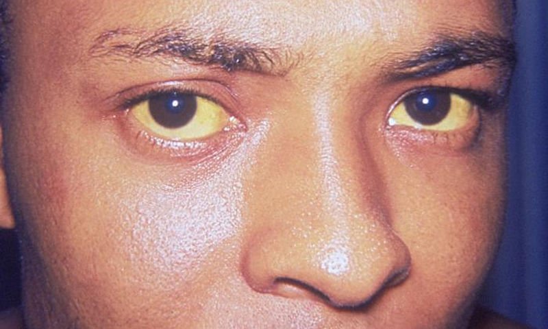 Κίτρινα μάτια: Αίτια, συμπτώματα και διάγνωση
