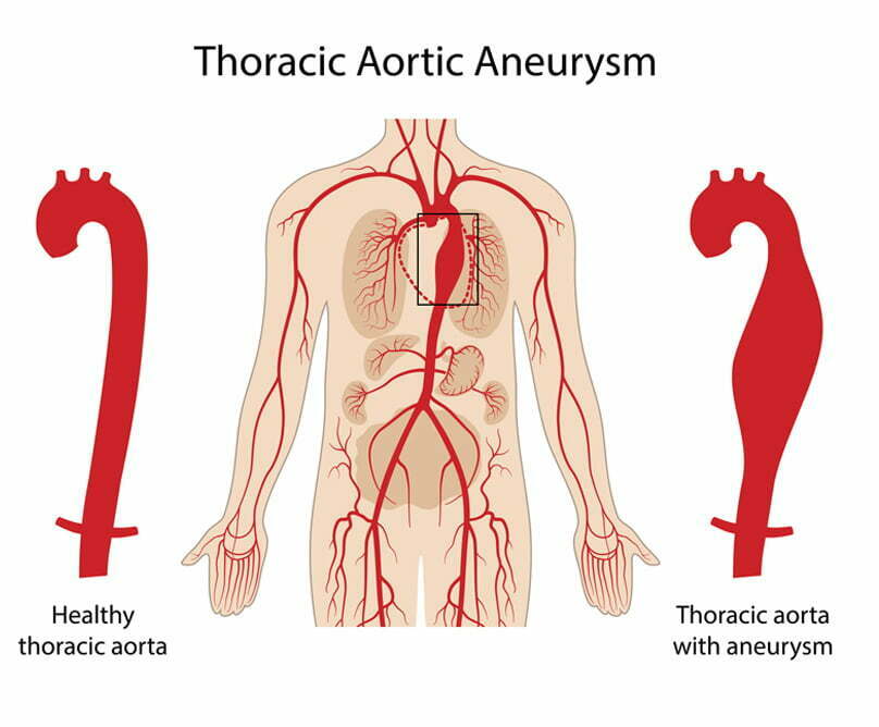 Διακαθετηριακή αντιμετώπιση ανευρυσμάτων