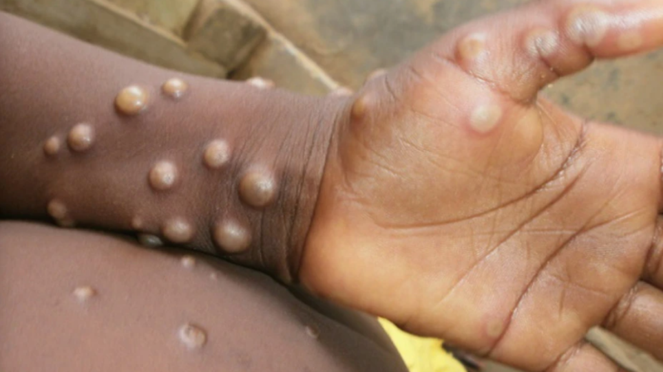 Τζανάκης: Τελείως διαφορετική νόσος η ευλογιά των πιθήκων από την παιδική ανεμοβλογιά