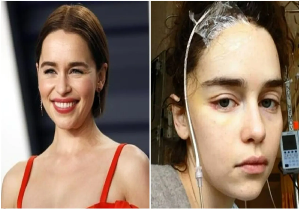 Εμίλια Κλαρκ: «Μετά τα ανευρύσματα δεν λειτουργεί μεγάλο μέρος του εγκεφάλου μου»