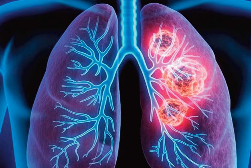 Ιδιοπαθής πνευμονική ίνωση: Η ύπουλη απειλή