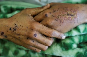 Συρία: Δεκάδες θάνατοι από την επιδημία χολέρας