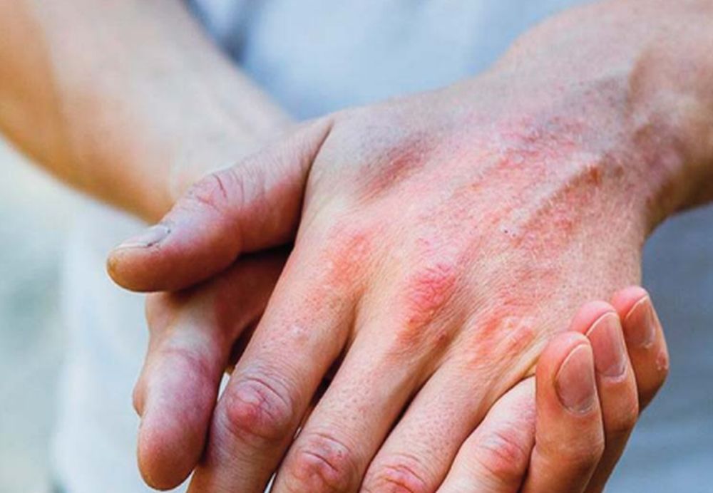 Κάψιμο στο δέρμα: Σπιτικές θεραπείες για να το αντιμετωπίσετε και τι να αποφεύγετε