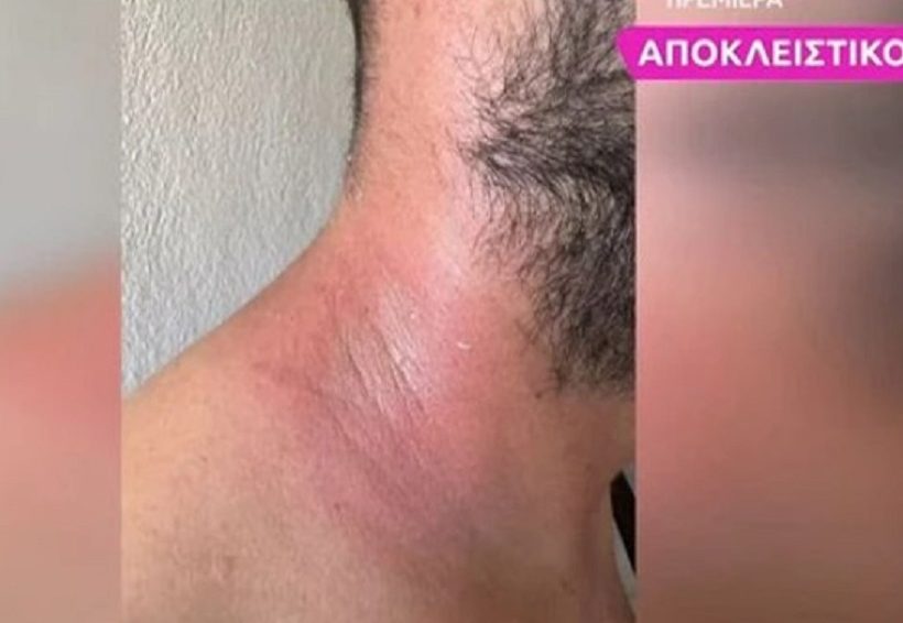 Κάτοικος Μαραθέας Καρδίτσας: «Ο σύζυγός μου εμφάνισε εξανθήματα σε όλο του το σώμα από τα μολυσμένα νερά» (Video)