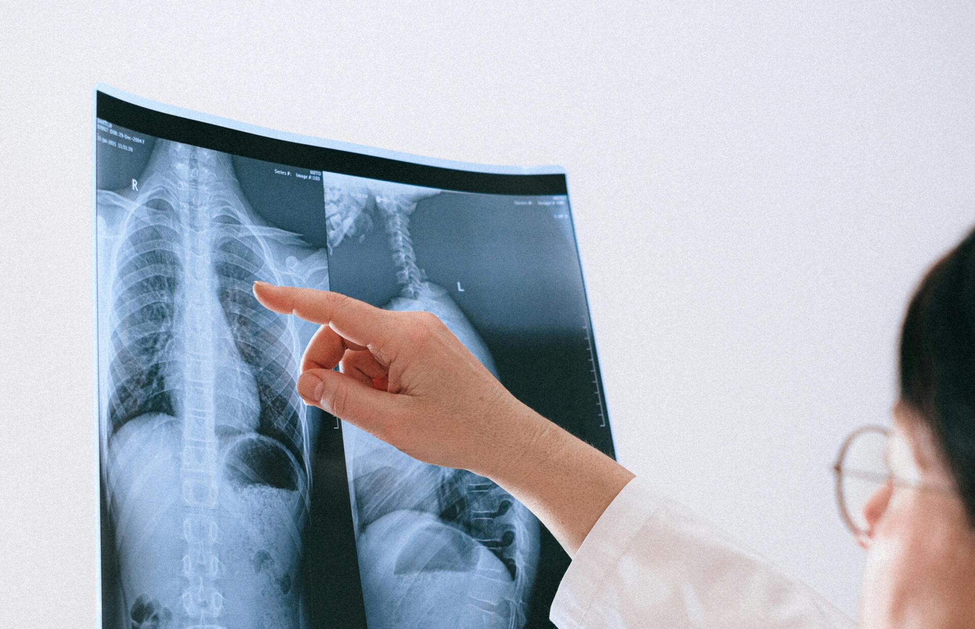 Η γυναικομαστία συνδέεται με αυξημένο κίνδυνο θανάτου