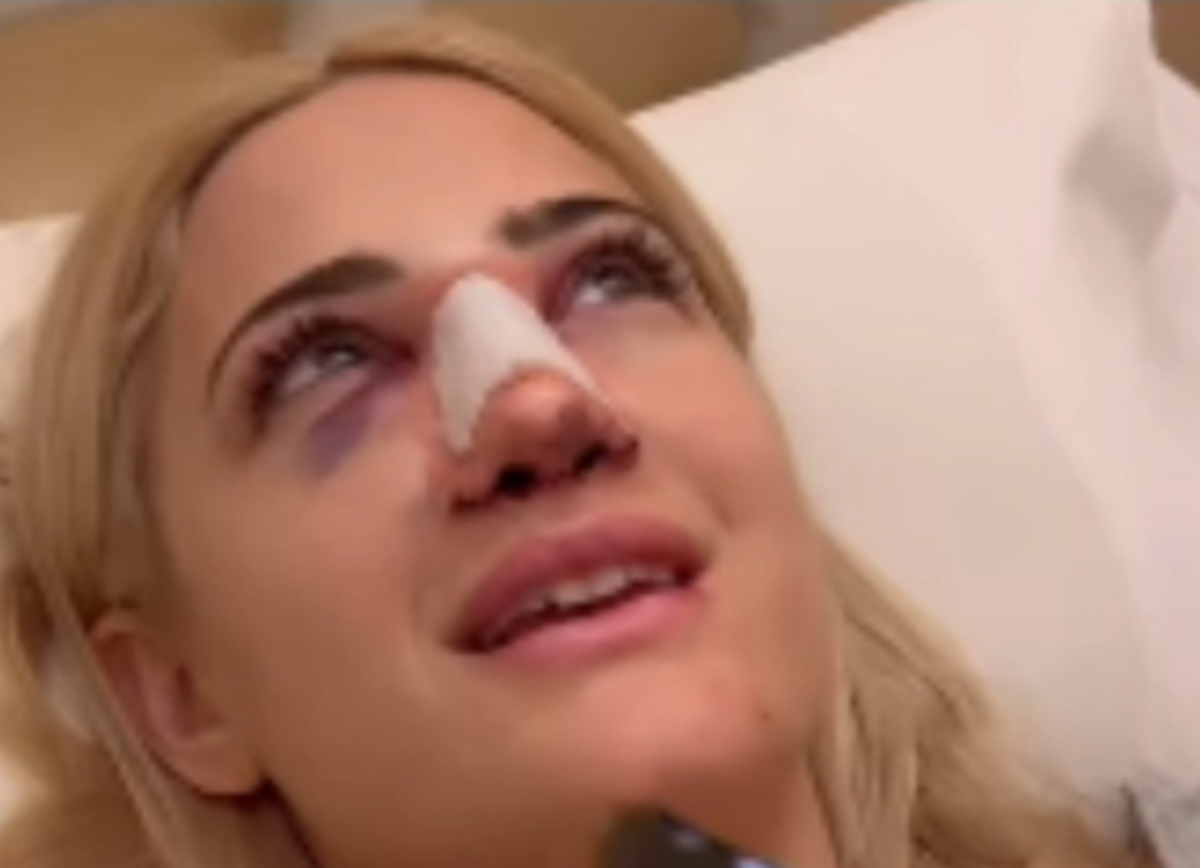 Ιωάννα Τούνη: Αγνώριστη μετά από την επέμβαση στη μύτη – Πρησμένη και με μώλωπες (Video)