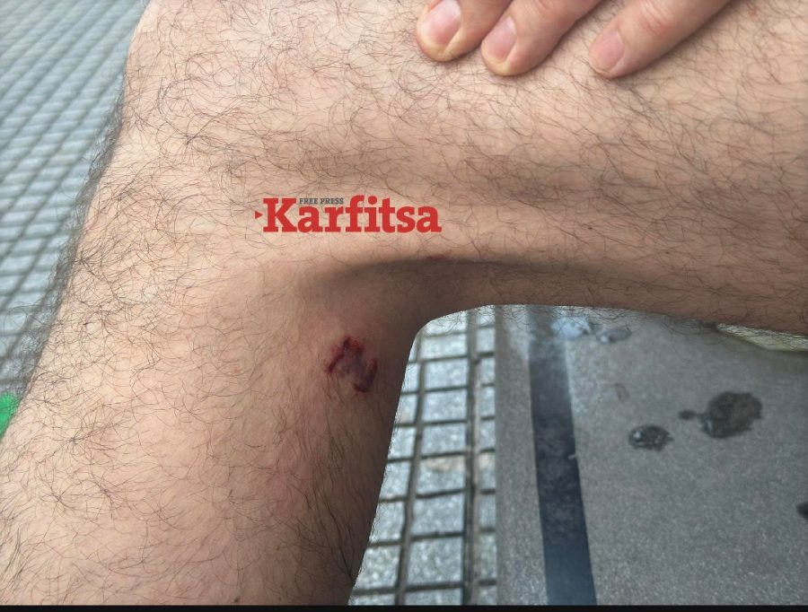 Θεσσαλονίκη: Επίθεση σκύλου σε τουρίστα - Τον δάγκωσε στο πόδι (ΦΩΤΟ)