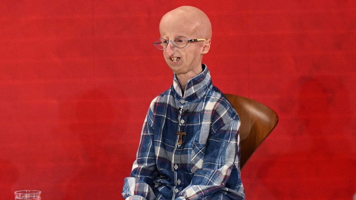 Σάμι Μπάσο: Πέθανε στα 28 του ο άνθρωπος που γεννήθηκε γερασμένος