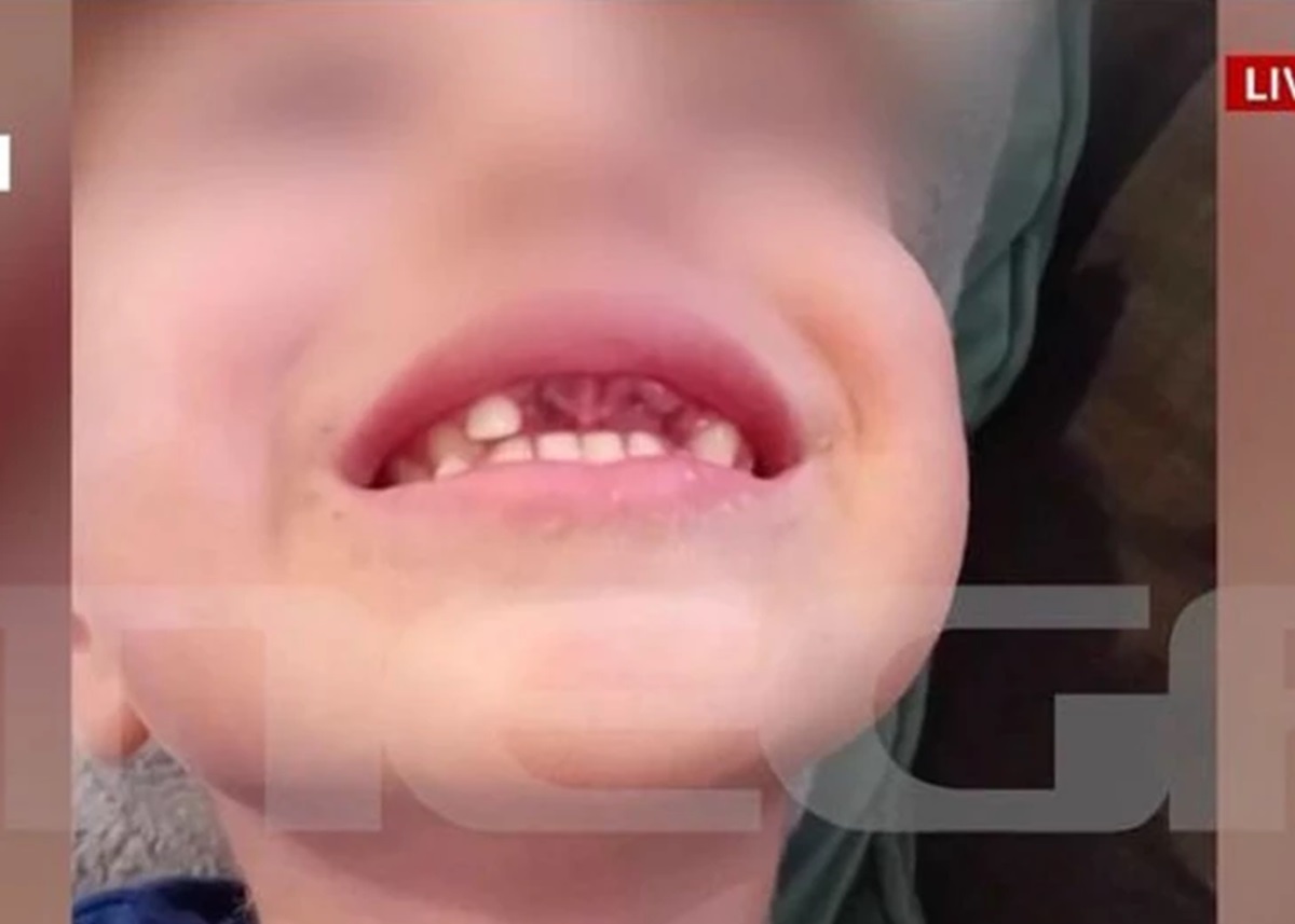 Βία ανηλίκων: Μητέρα κατήγγειλε τον ξυλοδαρμό του 4χρονου γιου της από 5χρονους – Του έσπασαν τα δόντια