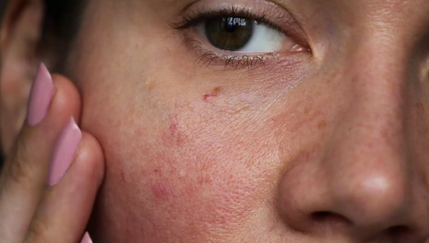 Ροδόχρους ακμή: Νέα, πολλά υποσχόμενη θεραπεία για την πάθηση ενέκρινε ο FDA