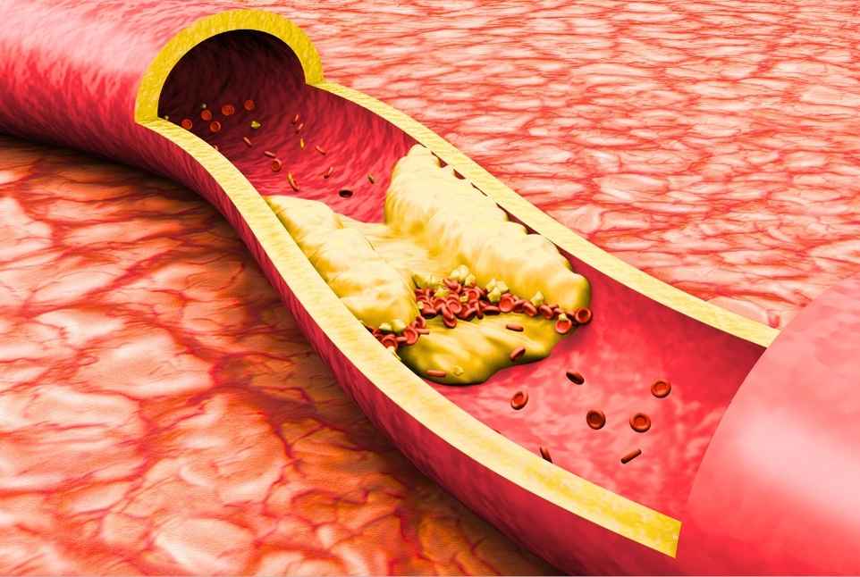 Αυξημένη χοληστερίνη: Ποια είναι τα δύο προειδοποιητικά σημάδια στο πρόσωπο