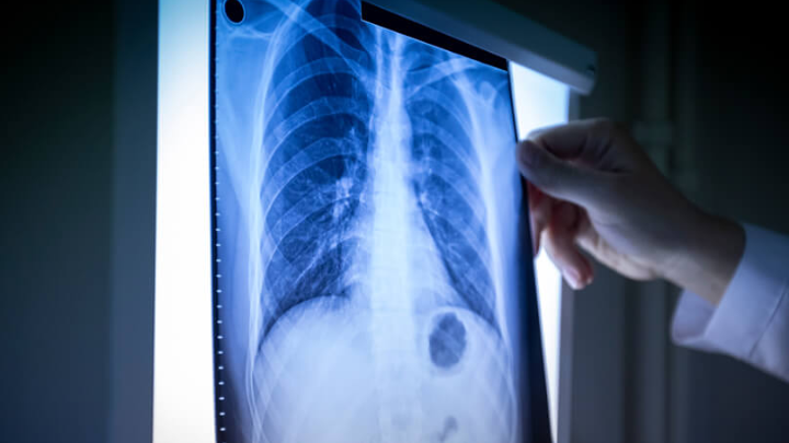 Πνευμονία: Διάγνωση – Θεραπεία – Πρόληψη