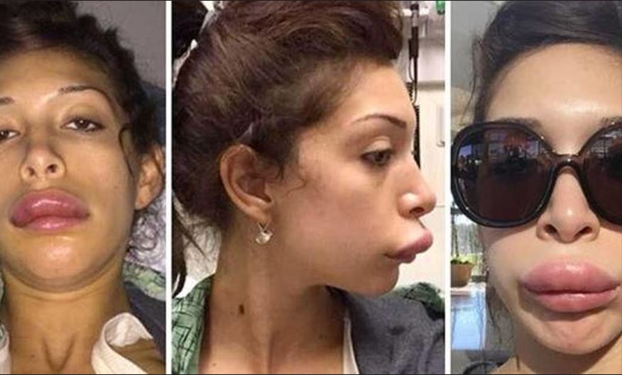 Προσοχή: Μην κάνετε ποτέ fillers σε αυτό το σημείο