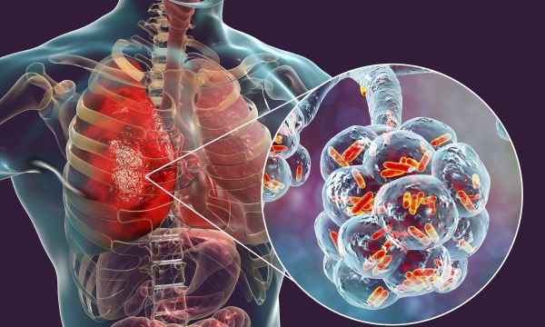 Πνευμονία: Ποια είναι τα συμπτώματα όταν προκαλείται από γρίπη, κρυολόγημα ή μικρόβια
