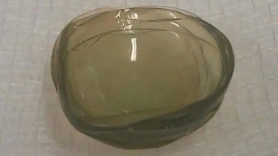 Γιατροί εντόπισαν 27 φακούς επαφής στο μάτι γυναίκας πριν από επέμβαση καταρράκτη