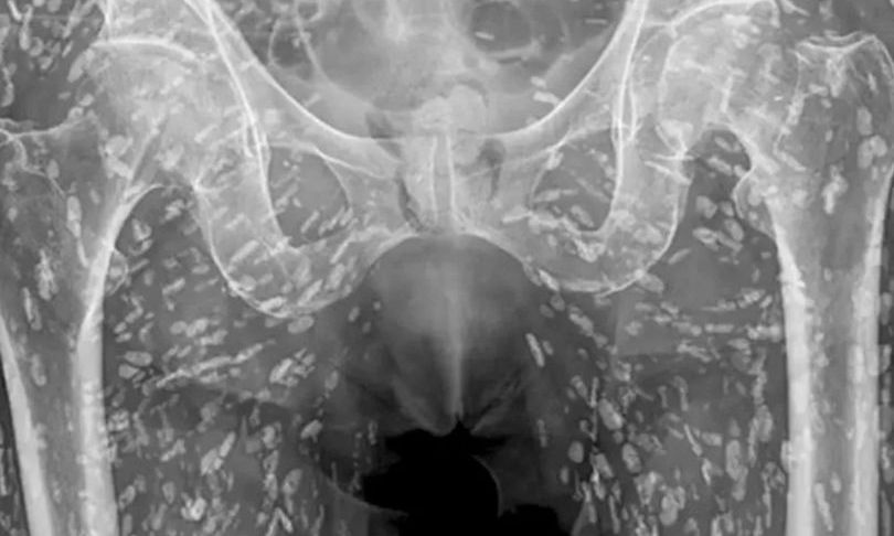 Aκτινογραφία δείχνει άνδρα «γεμάτο αυγά» – Το λάθος που έκανε στην κουζίνα – Πως του προκλήθηκαν