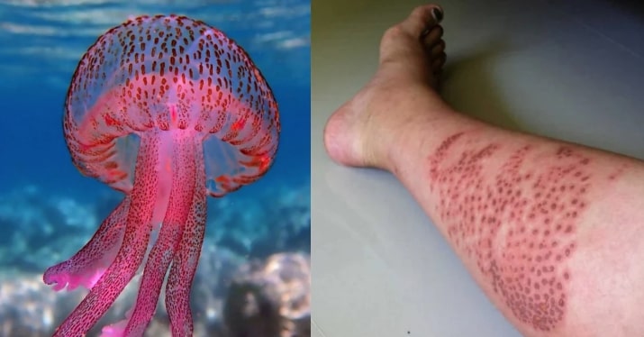 Προσοχή: Επανεμφανίστηκαν οι μωβ μεδουσες – Τι να κάνουμε αν μας τσιμπήσουν