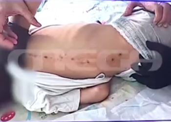 Θρίλερ με τα σημάδια στην πλάτη 7χρονου ΑμεΑ στην Πάτρα (video)