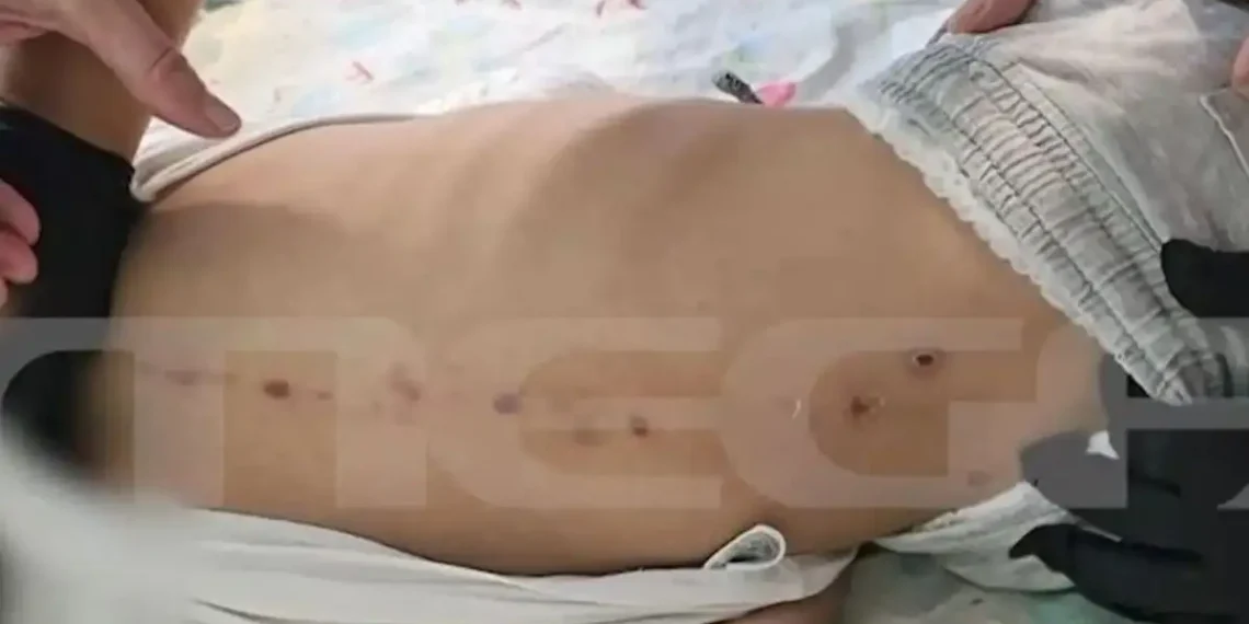 Νέα μαρτυρία για τα σημάδια στην πλάτη του 10χρονου στην Πάτρα (video)