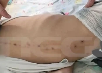 Νέα μαρτυρία για τα σημάδια στην πλάτη του 10χρονου στην Πάτρα (video)