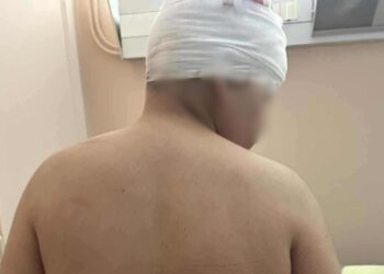 Άγριος ξυλοδαρμός 13χρονου στις Συκιές – Για απόπειρα ανθρωποκτονίας διώκεται ο 18χρονος