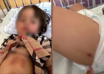 Χαλκιδική: Σοκαριστικά τα τραύματα του κοριτσιού που δέχθηκε επίθεση από λύκο (video)