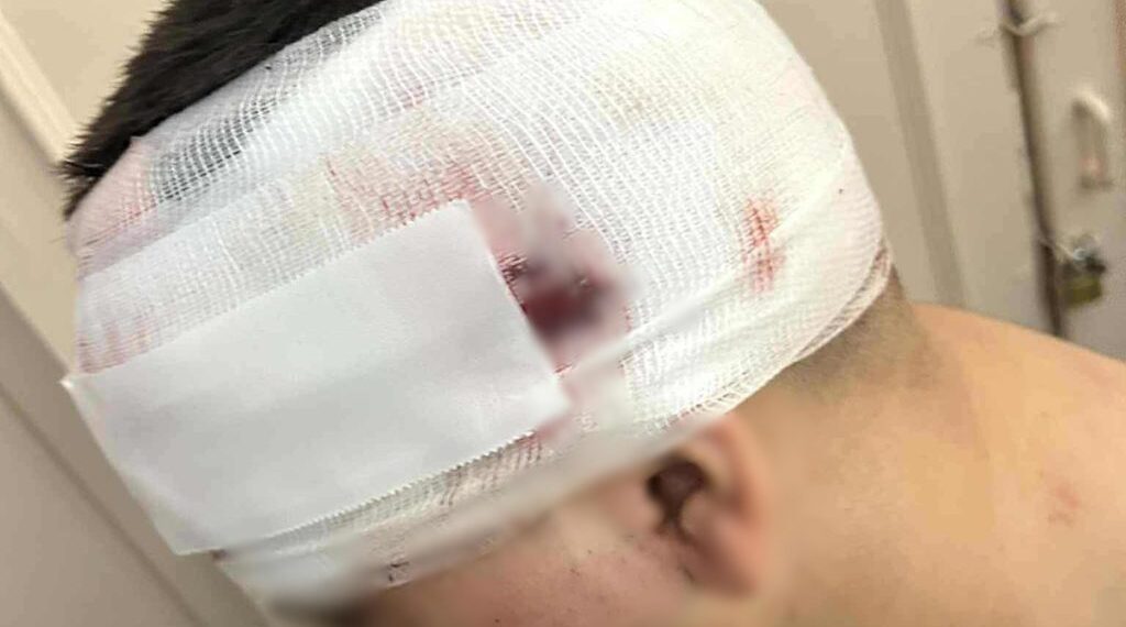 Συκιές: Συνολικά 11 άτομα επιτέθηκαν στον 13χρονο – Στον εισαγγελέα ο 18χρονος