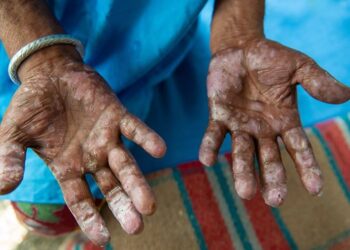 Αναστάτωση στη Ρουμανία: Δύο κρούσματα λέπρας σε κέντρο ευεξίας στην Κλουζ μετά από 44 χρόνια