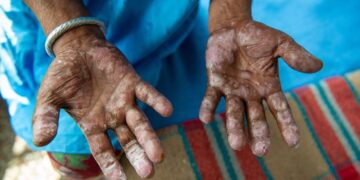 Αναστάτωση στη Ρουμανία: Δύο κρούσματα λέπρας σε κέντρο ευεξίας στην Κλουζ μετά από 44 χρόνια