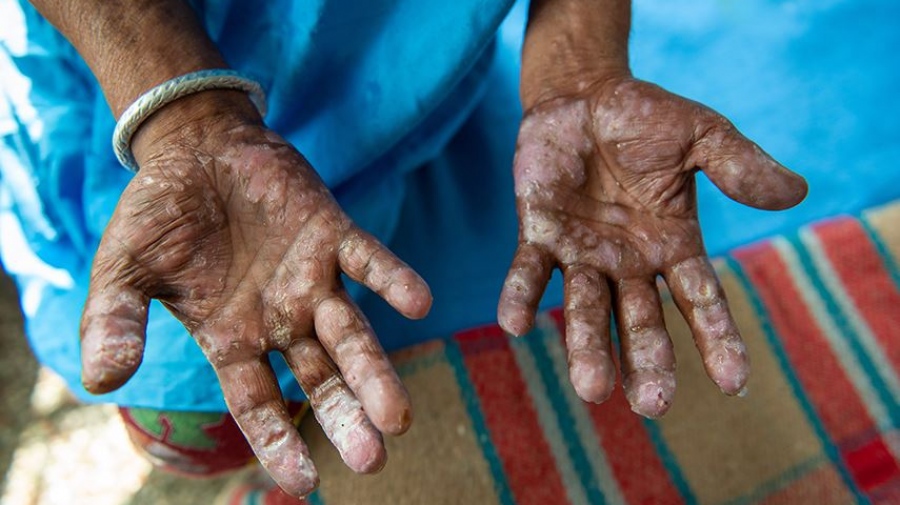 Αναστάτωση στη Ρουμανία: Δύο κρούσματα λέπρας σε κέντρο ευεξίας στην Κλουζ μετά από 44 χρόνια