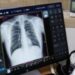 Κυστική Ίνωση: 500.000 φορείς και πάνω από 900 οι ασθενείς στην Ελλάδα